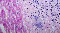 sarcoidosis
